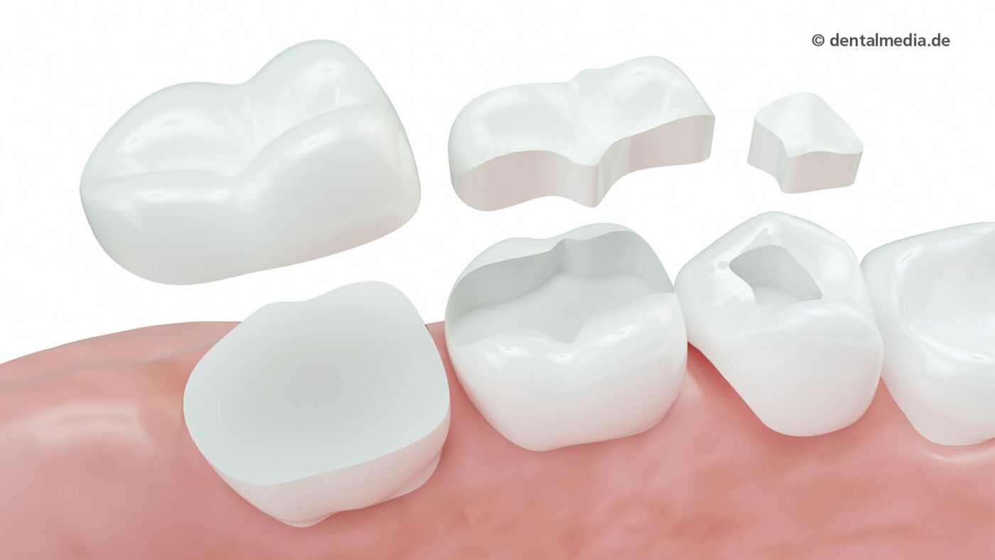 Inlay, Onlay und Overlay von Ihrem Zahnarzt